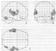 Beszd-aktivcis agyvizsglat parametrikus kpei